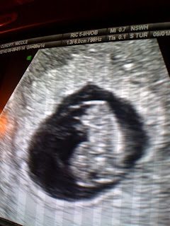 Ultrasound of early embryo in gestational sac